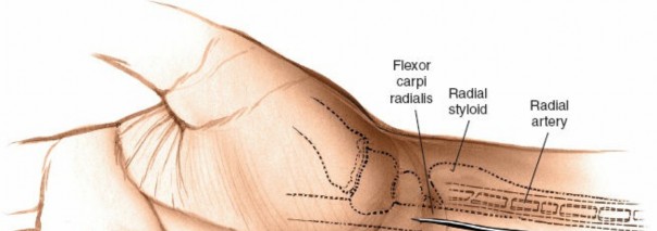 Illustration 2 for Volar Approach: Optimal Exposure for the Volar aspect of the Distal Radius