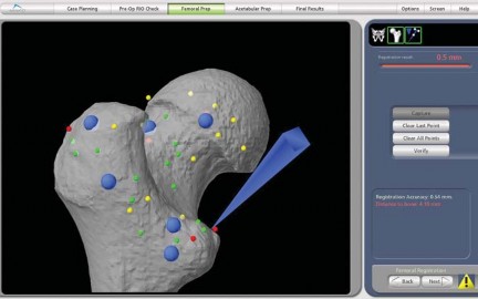 Illustration 20 for Robotics in Total Hip Arthroplasty: A New Era of Precision