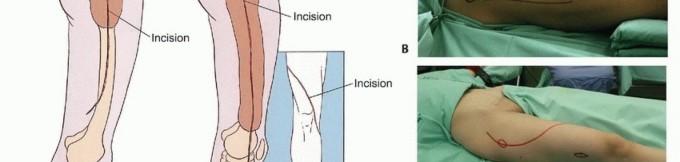Illustration 17 for Beyond Amputation: Total Femur Resection with Endoprosthetics