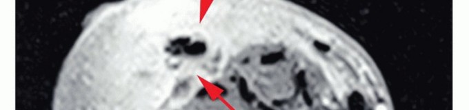 Illustration 13 for Above-Elbow & Below-Elbow Amputations: When & Why They're Needed