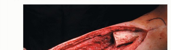 Illustration 16 for Free Vascularized Fibular Grafts: Solving Complex Bone Defects