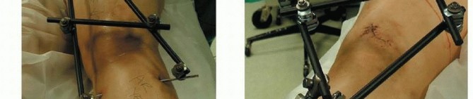 Illustration 39 for Repairing Distal Femur Fractures: Open Reduction & Internal Fixation