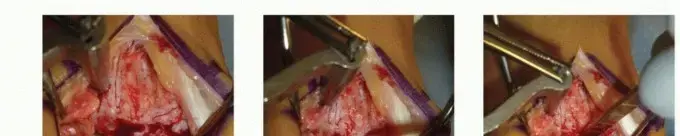 تلف غضروف الكاحل: العلاج المبتكر بزراعة الغضاريف اليافعة (PJCAT) مع الأستاذ الدكتور محمد هطيف