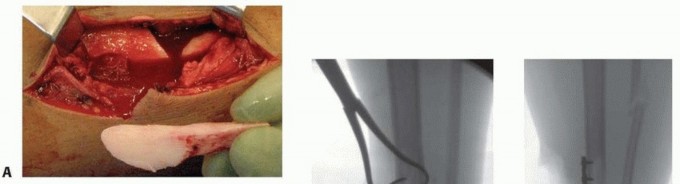 Illustration 34 for Advanced Nailing of the Mature Tibia: Overcoming Complexities