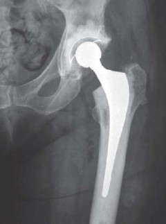 Illustration 30 for Optimizing Acetabular Component Cementation for Superior Outcomes