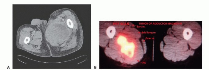Illustration 4 for Optimizing Adductor Muscle Group Resection for Limb Preservation