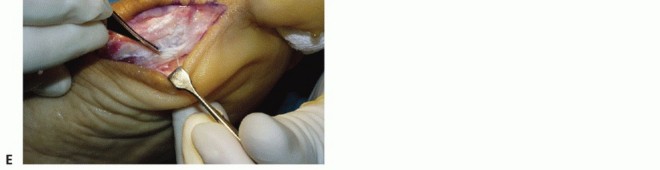 Illustration 21 for Restore Your Foot: Surgical Treatment for Hallux MP Joint Turf Toe