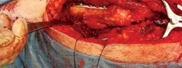 Illustration 143 for Successful Total Hip Replacement in Developmental Dysplasia