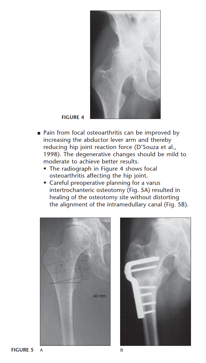 Illustration 3 for Intertrochanteric Femoral Osteotomy: Indications for Hip Preservation