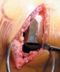 Illustration 18 for Knee Arthroplasty Unicondylar: Discover if Partial Knee Replacement is Right