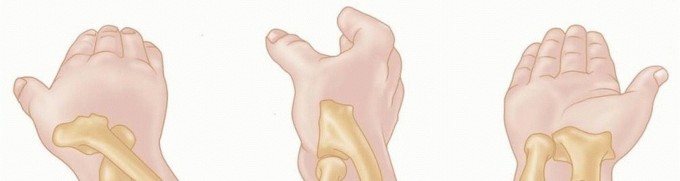 Restore Stability: Fixation of Radial Head & Neck Fractures