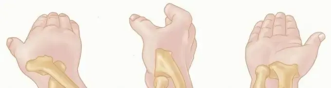 صورة توضيحية لـ كسور رأس وعنق عظم الكعبرة: دليل المريض الشامل لاستعادة حركة المرفق باليمن والخليج