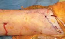 Illustration 53 for Optimizing ORIF for Tibial Plafond Fractures: A Modern Approach