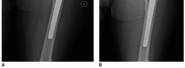 Illustration 26 for Extended Trochanteric Osteotomy: How et al Extended Revision THA Solutions