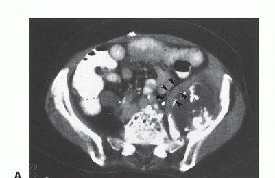 Illustration 12 for Surgical Pelvic Resection: Gluteus Maximus Muscle & Nerve Preservation