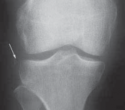 Illustration 2 for Optimizing Single-Bundle Anterior Cruciate Ligament Repair