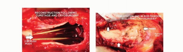 Illustration 10 for Avoid Major Surgery: Bone Tumor Treatment with Liquid Nitrogen Pour