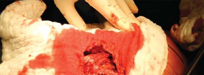 Illustration 62 for Metal on Metal Resurfacing: Enhanced Posterior Soft Tissue Repair