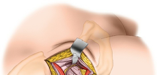 Illustration 91 for Unlocking Every Aspect of the Hip's Surgical Approaches