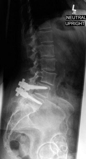 Illustration 6 for Adjacent Segment Degeneration: Your Next Spine Case Solved
