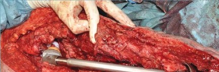 Illustration 79 for Optimizing Infected THA: The One Staged Approach Explained