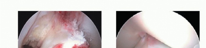 Illustration 13 for Treating Tibial Spine Fractures: Arthroscopy or Open Reduction?