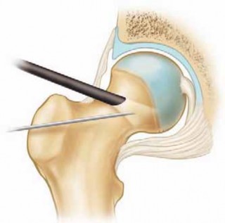 Illustration 18 for Solving Hip Soft Tissue Pathology with Advanced Arthroscopy