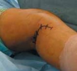 Illustration 21 for Cruciate Ligament Repair: Definitive Guide to Treatment & Recovery