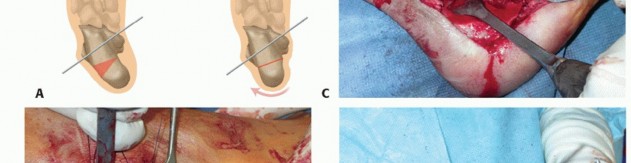 Illustration 36 for How Achilles Tendon Lengthening Fixes Equinocavovarus Foot