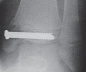 Illustration 29 for Pediatric Ankle Fractures: Management to Prevent Long-Term Issues