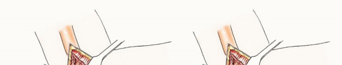 Illustration 40 for Restore Vital Function: Surgery for Type II Humeral Metastasis