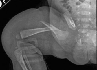 Cracking 11 Pediatric Cases: The Bar with Contralateral Guide