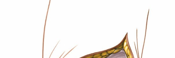 Illustration 176 for Mastering Knee Approaches: Spotlight on Superficial Medial Ligament