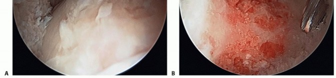 Illustration 33 for Hip Arthroscopy: Your Minimally Invasive Solution for Hip Pain