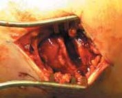 Illustration 27 for Optimal Fixation of the Ankle: Open Reduction & Internal Fixation