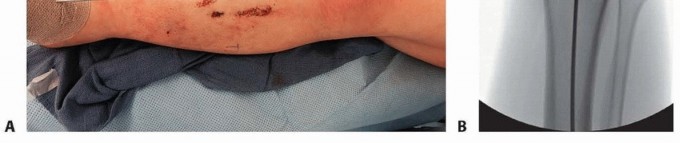 Illustration 20 for Advanced Nailing of the Mature Tibia: Overcoming Complexities