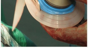 Illustration 10 for Cemented Acetabular Component: Achieving Optimal THA Stability