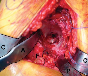 Illustration 30 for Mastering the Cementless Acetabular Cup: Techniques for Optimal Fixation