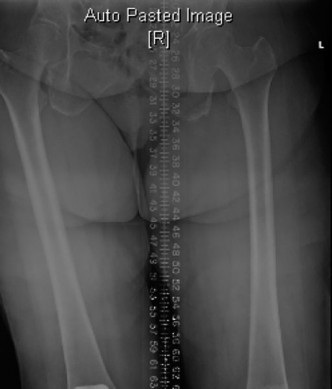 Illustration 3 for Unraveling Your Painful TKR: Diagnosing Infection & Loosening
