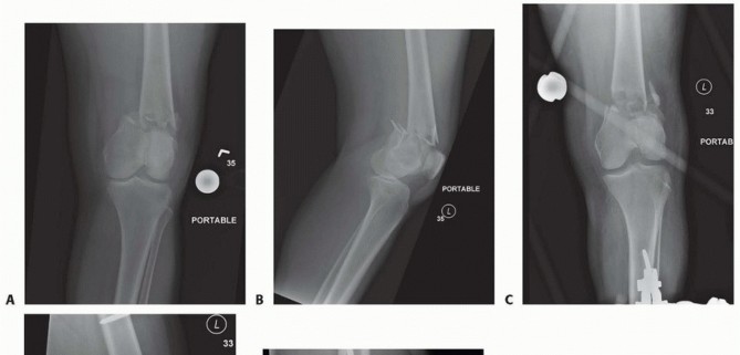 Illustration 20 for Repairing Distal Femur Fractures: Open Reduction & Internal Fixation