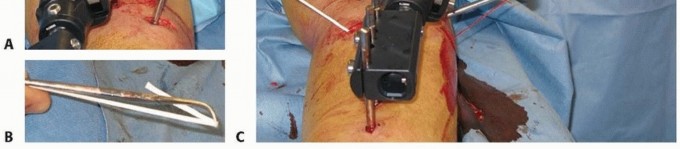 Illustration 7 for Solving Infantile Blount Disease: Surgical Management Strategies