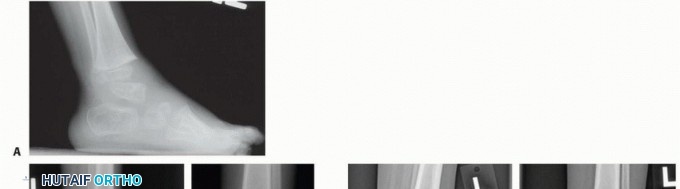 Illustration 9 for Optimizing Growth to Correct Pediatric Limb Deformities