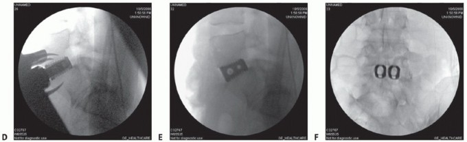 Illustration 11 for Anterior Lumbar Interbody: Fusion, Disc Replacement & Pain Relief