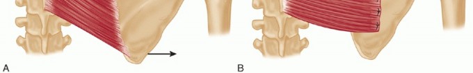 Illustration 17 for End CN XI Palsy Pain: The Eden-Lange Procedure Solution
