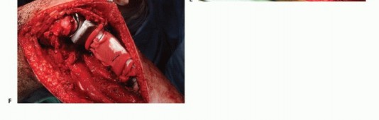 Illustration 37 for Tackling Complex Tumors of the Proximal Tibia: Limb-Sparing Solutions