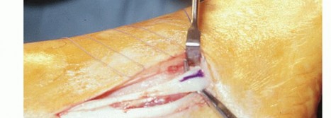 Illustration 3 for Beyond Primary Repair: Solutions for Peroneal Tendon Subluxation