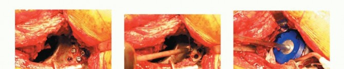 Illustration 17 for Revision Arthroplasty with Acetabular Bone Loss: The Antiprotrusio Cage