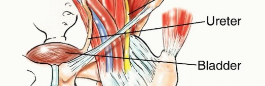 Illustration 5 for Pelvic Metastasis Surgery: A Component of the Utilitarian Approach