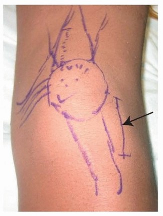 Illustration 9 for Chronic Patellar Instability: From Acute Onset to Lasting Solutions