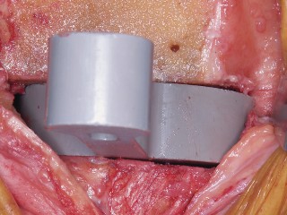 Illustration 35 for Mastering Valgus Total Knee Replacement: Techniques & Pitfalls